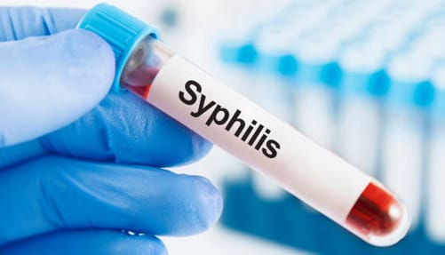 New Research Suggests Syphilis Originated in the Americas, Not Europe (1)