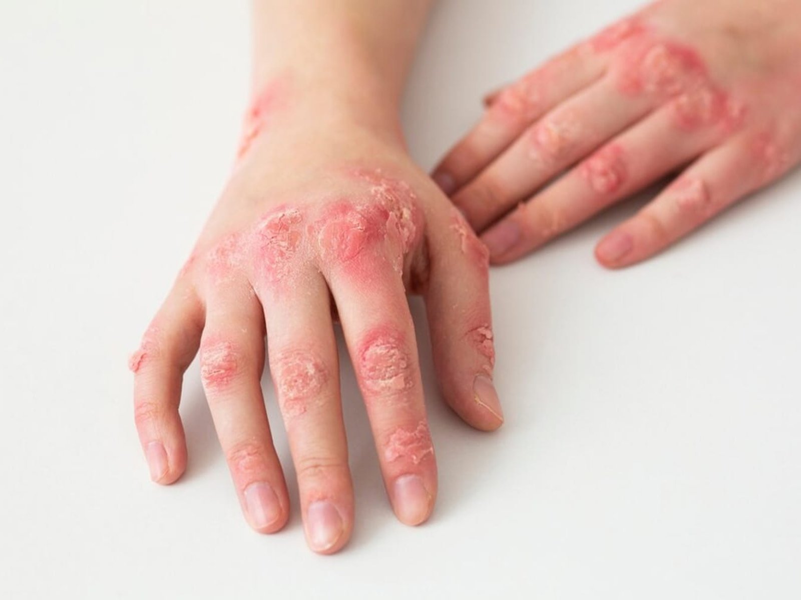 New Research Suggests Syphilis Originated in the Americas, Not Europe